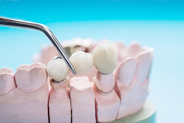 Dental Bridge Vs Dental Crowns: What Is The Difference?