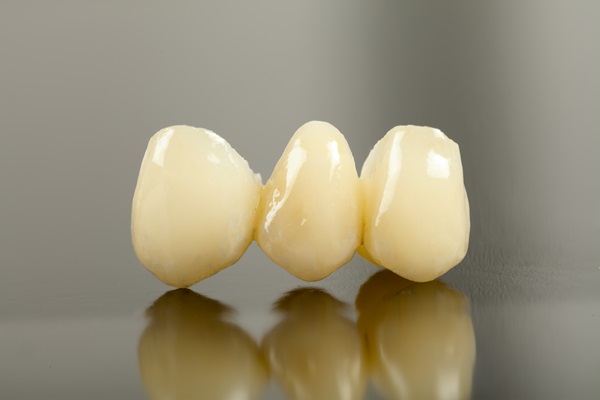 Dental Bridge Vs  Implants: Which Tooth Replacement Option Is Right For You?