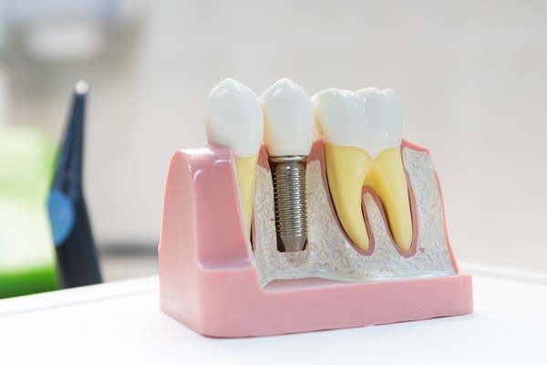 Avoiding Infection With Dental Implants